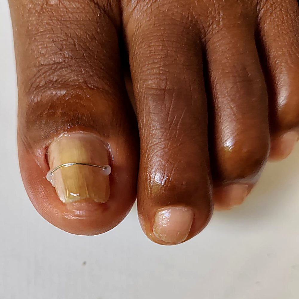 Unha do dedão com o fio de aço da correção de unha encravada aplicado